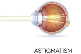 Astigmatism