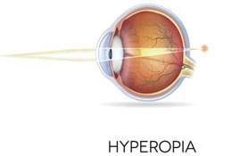 Hyperopia