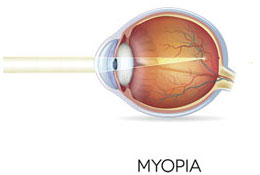 Myopia